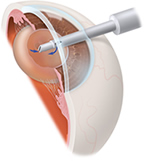 Cataract Surgery | Lens Implantation | Manchester