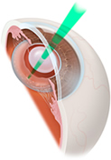 Posterior Capsulotomy Manchester