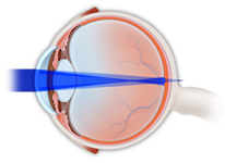 Astigmatism Correction Manchester