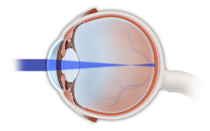 Myopia Correction | Nearsightedness Correction | Manchester