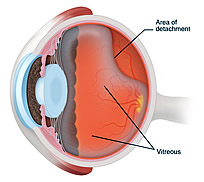 Detached Retina Surgery