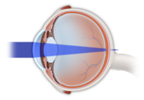 Presbyopia Treatment Manchester MA | Gloucester MA