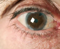 Cataract Treatment | Cataract Surgery Manchester MA | Gloucester MA